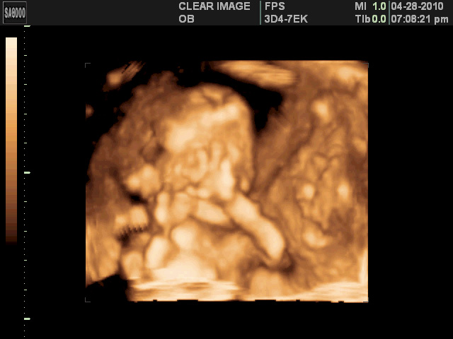 3d ultrasound 20 weeks boy. The ideal time to have 3D/4D
